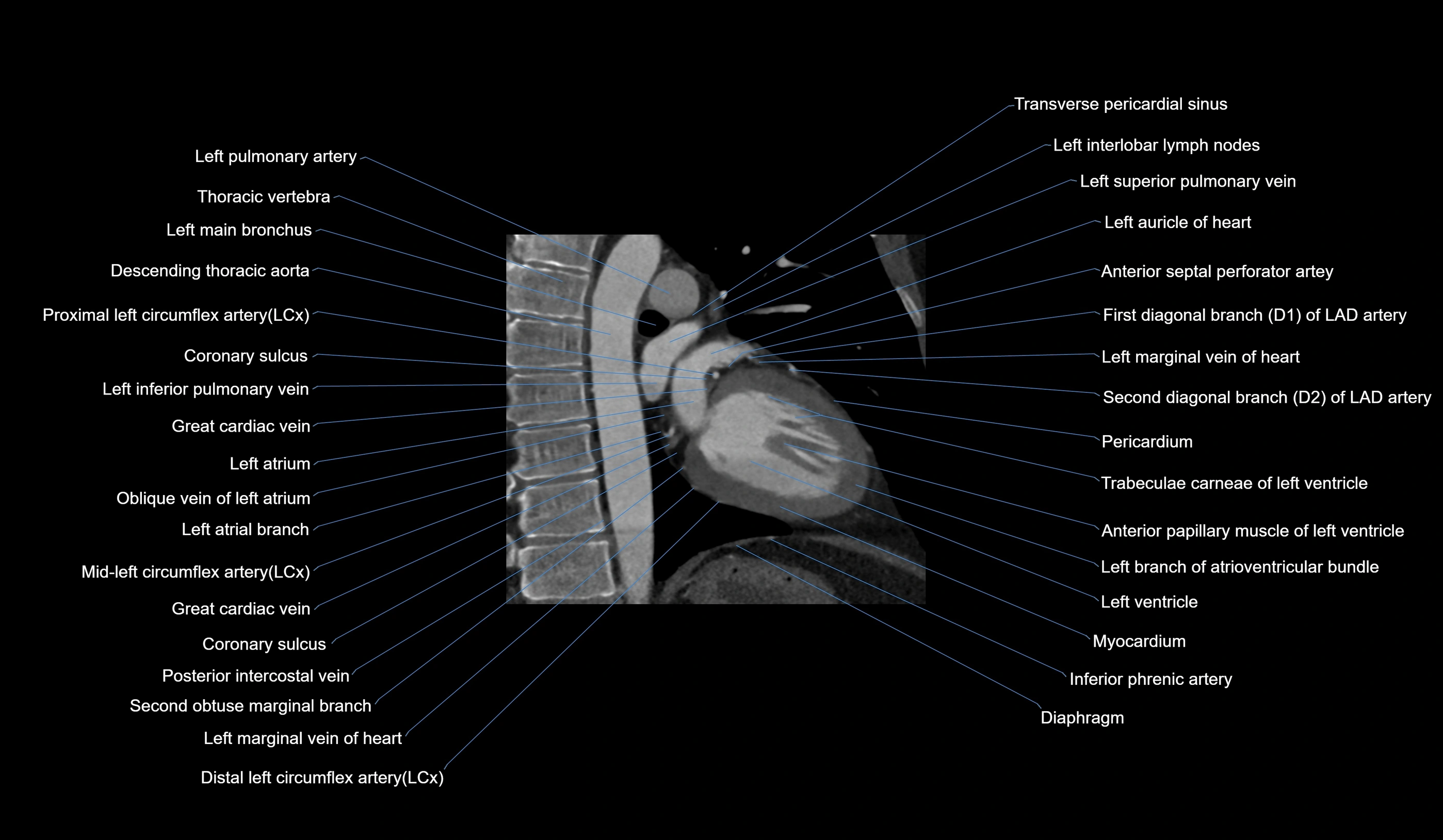 CT heart (coronary angiogram) 2 chamber view cross sectional anatomy labelled radiology image-00009.webp